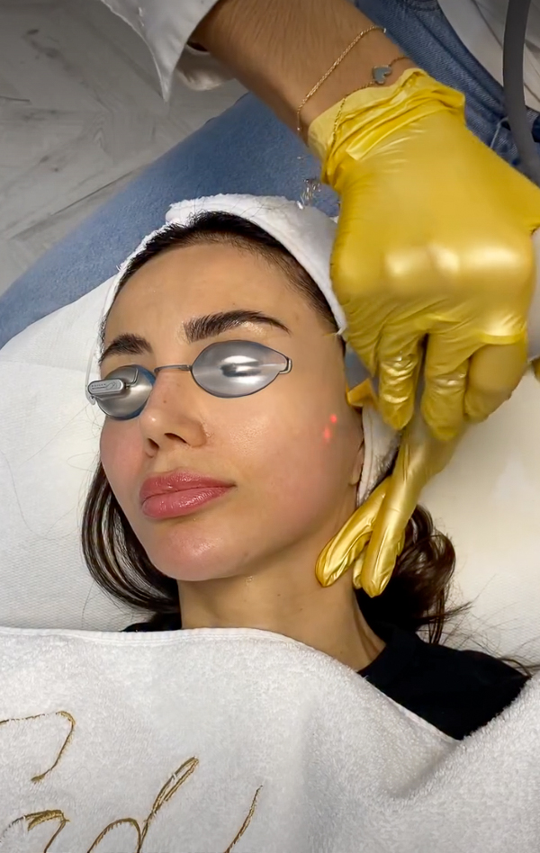 Fotorejuvenecimiento (IPL), IG @sadaf_jaffari | Treatwell