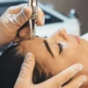 Primer plano de un tratamiento profesional de microneedling en el rostro de una mujer en una clínica