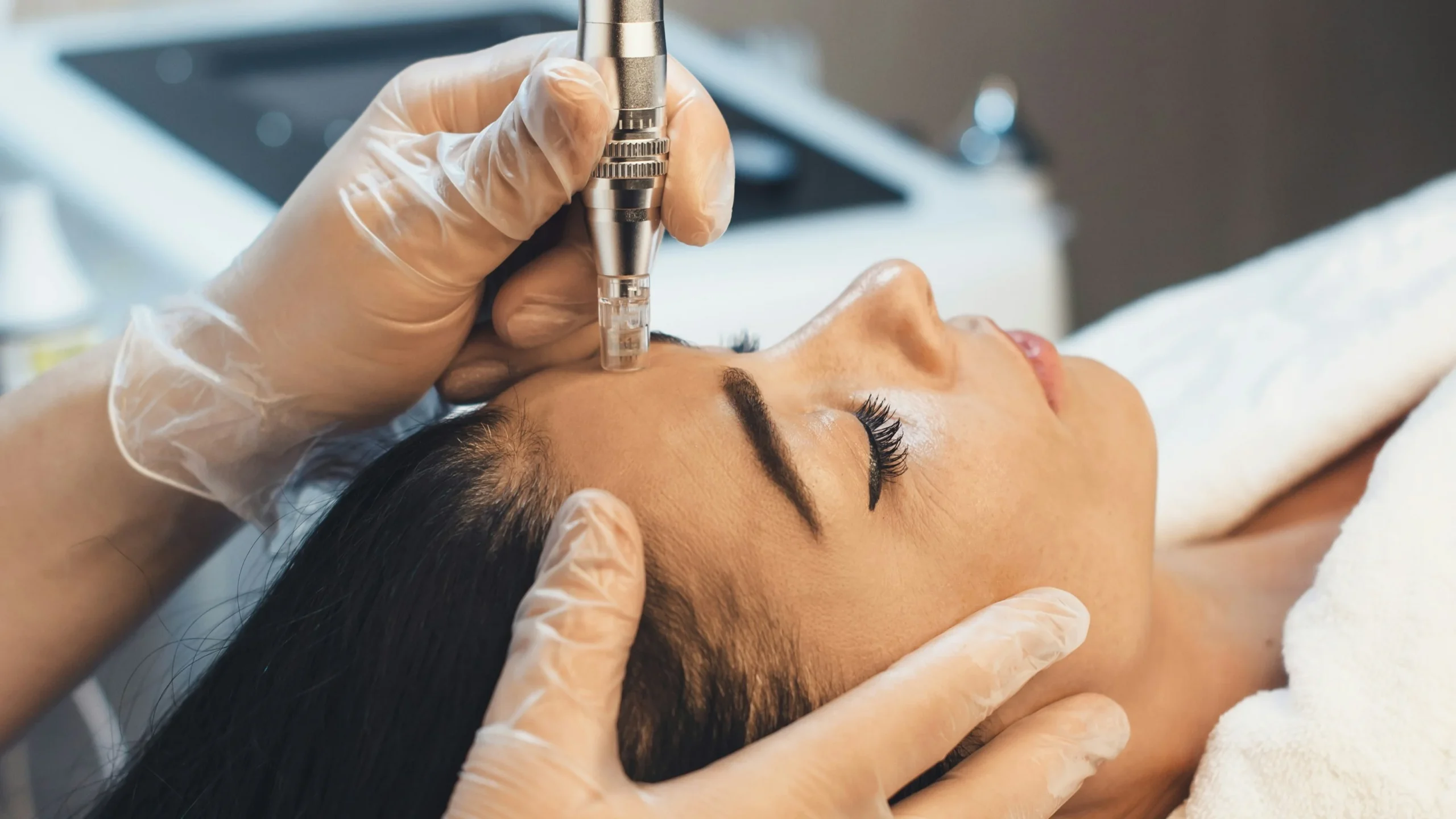Primer plano de un tratamiento profesional de microneedling en el rostro de una mujer en una clínica