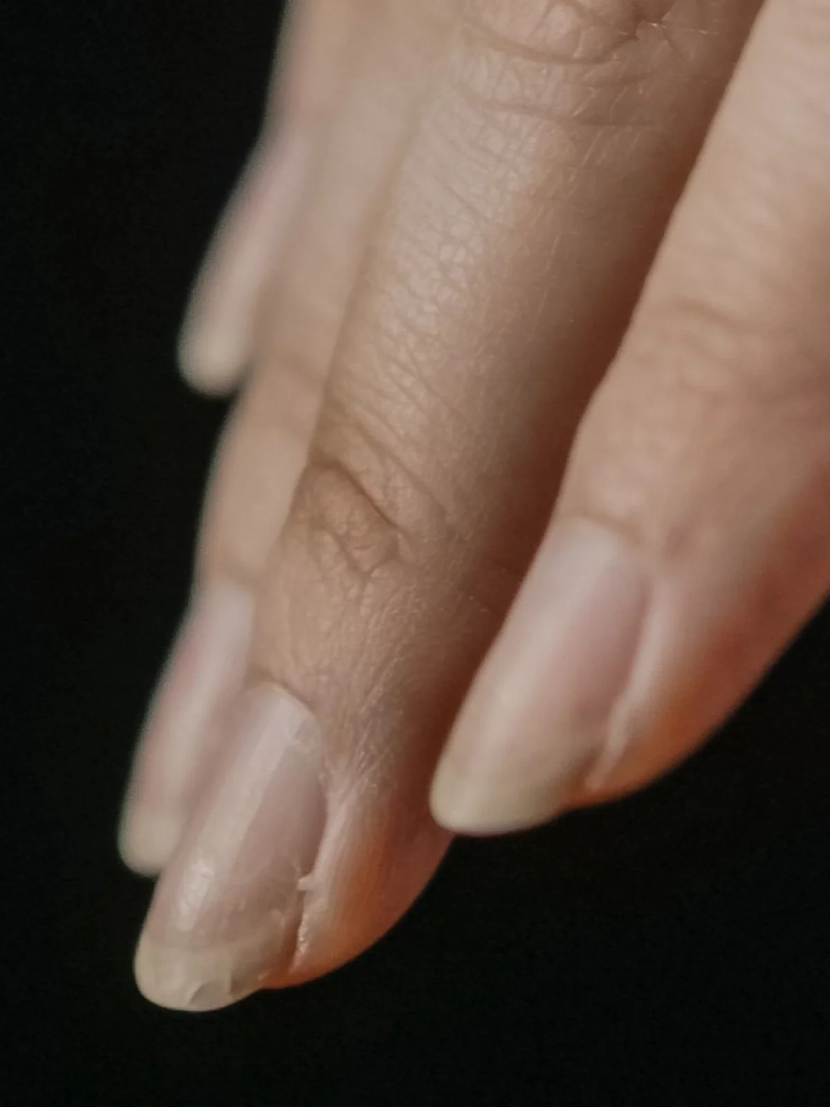 Primer plano de varias uñas con descamación en el borde libre